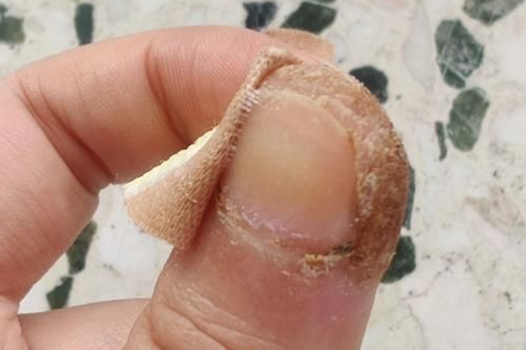 甲周疣指甲两边硬角质图