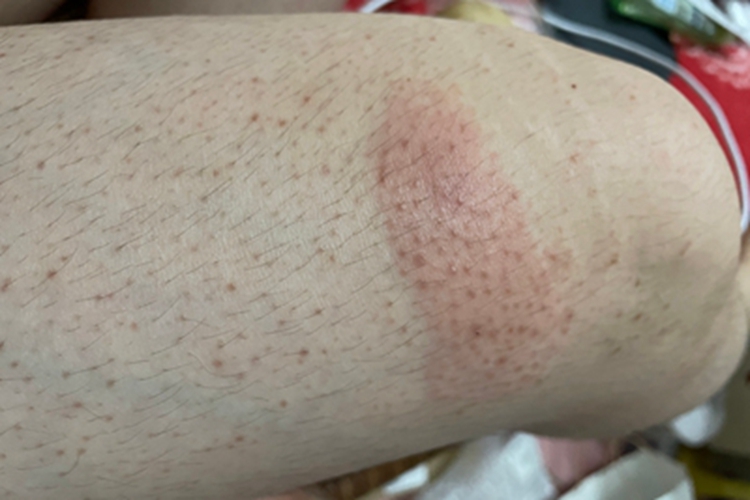 过敏性皮炎大腿结节图