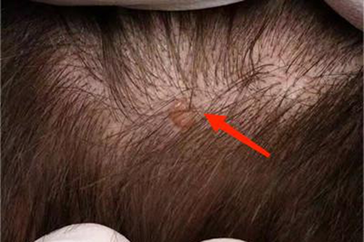 女性乳头状汗腺腺瘤头皮症状图 女性乳头状汗腺腺瘤头皮症状图