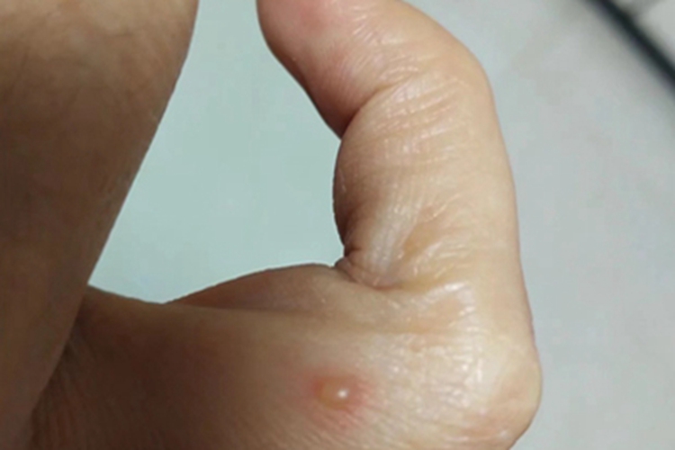 水痘手指水疱图 水痘手指水疱图