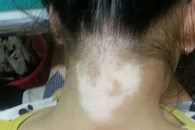 脖子白癜风图 脖子白癜风图