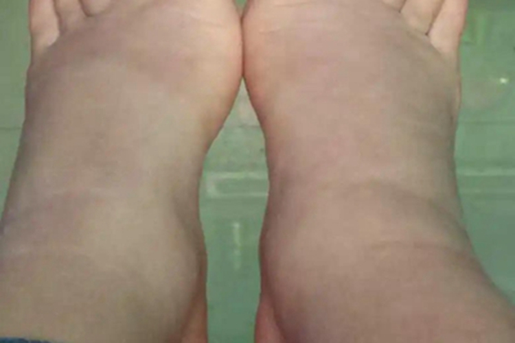 蛋白质营养不良双脚水肿图