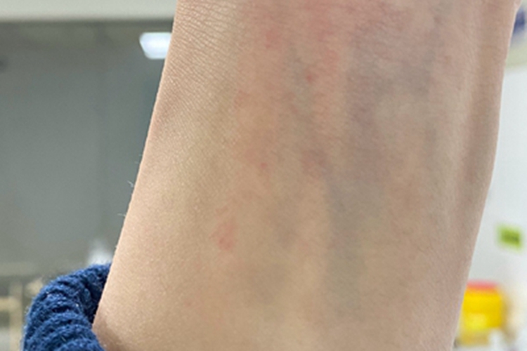 青霉素过敏手腕红斑图 青霉素过敏手腕红斑图