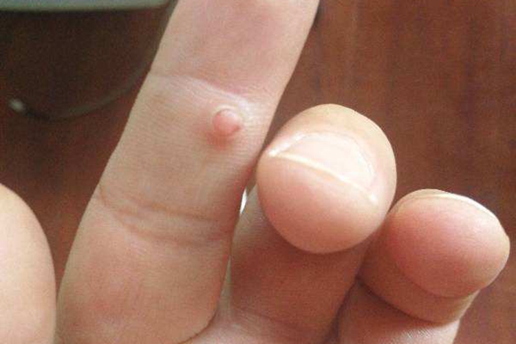 孩子手上长鸡眼图 孩子手上长鸡眼图