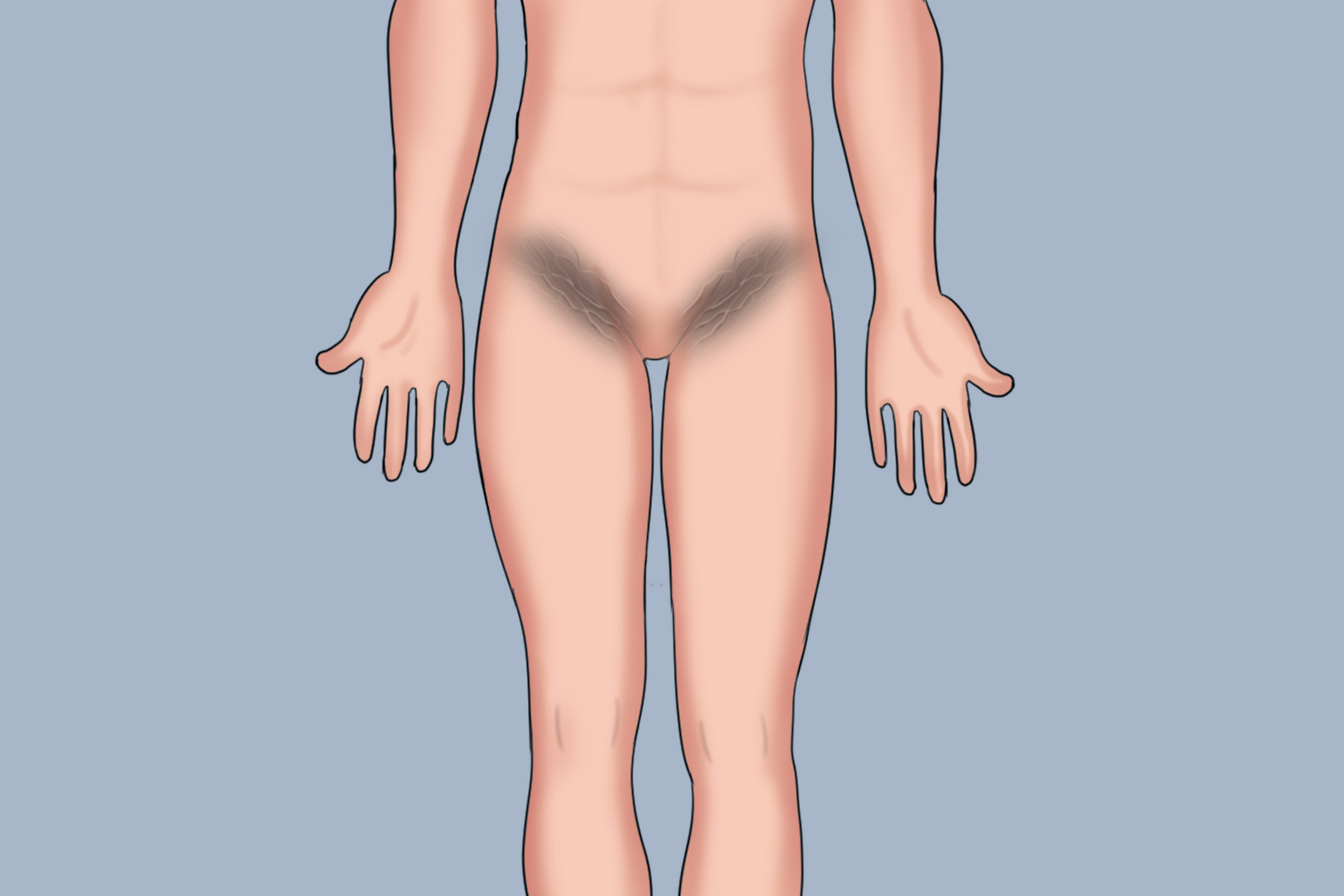 腹股沟黑棘皮症状图 腹股沟黑棘皮症状图