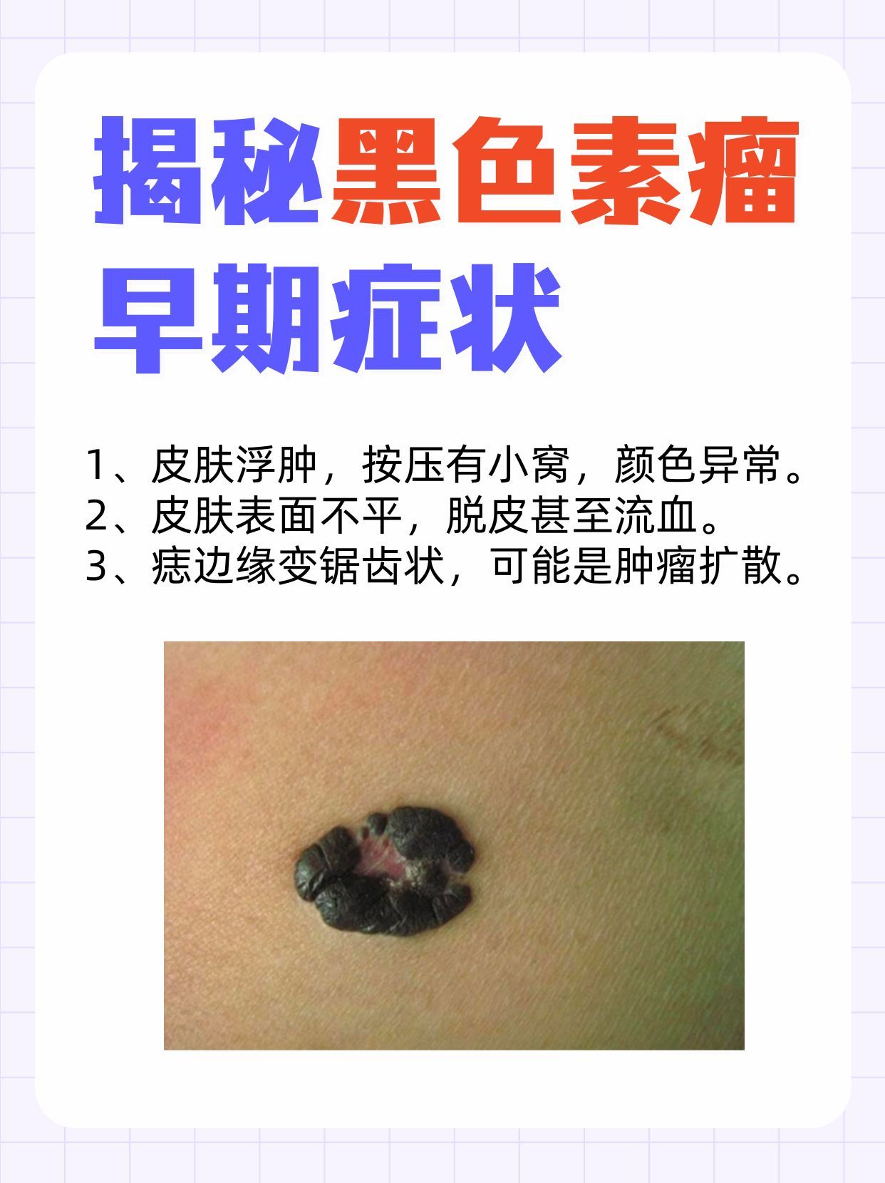 出现这几种表现，小心是早期黑色素瘤在作怪！