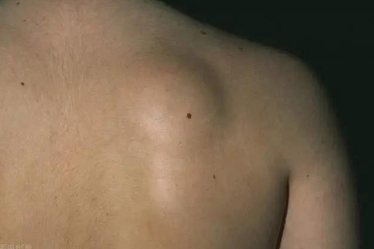 肩膀脂肪肉瘤图 肩膀脂肪肉瘤图