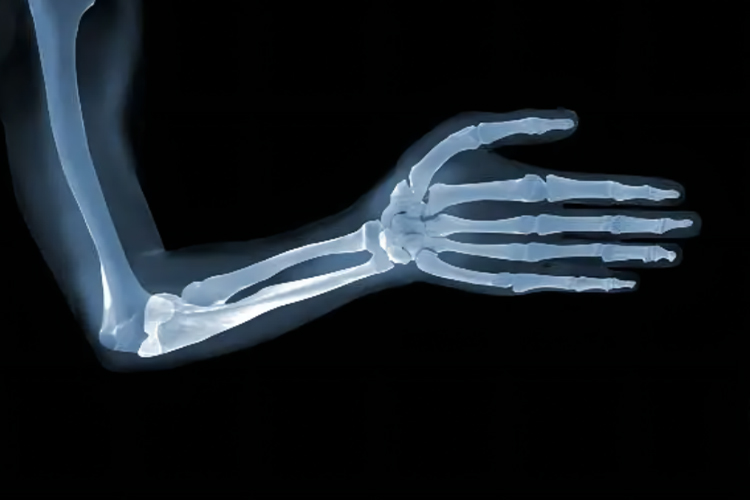手臂X光图