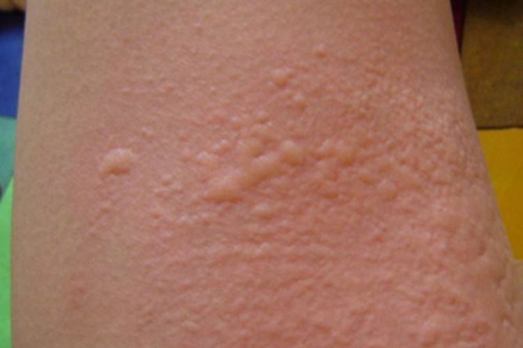 成人痒疹胳膊有许多扁平小疙瘩图 成人痒疹胳膊有许多扁平小疙瘩图