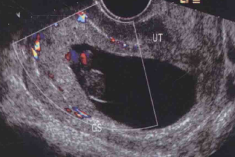 怀孕2个月胎儿超声图