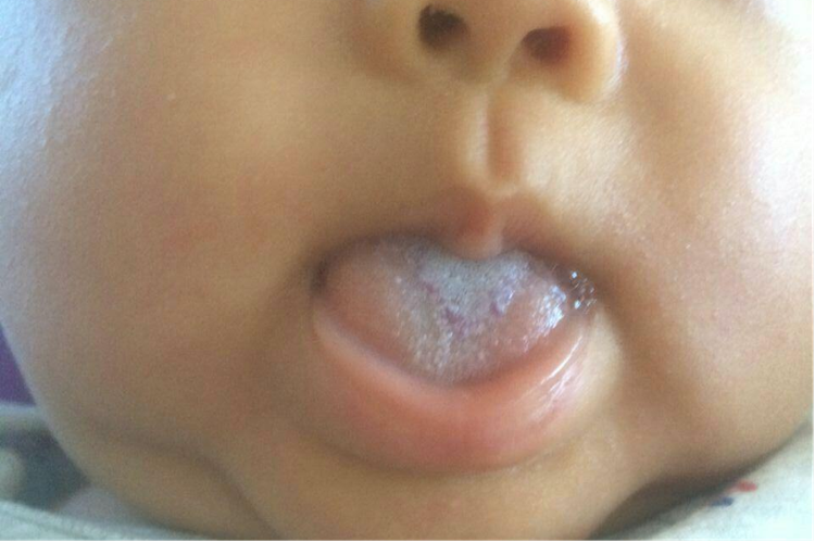 口腔念珠菌病图