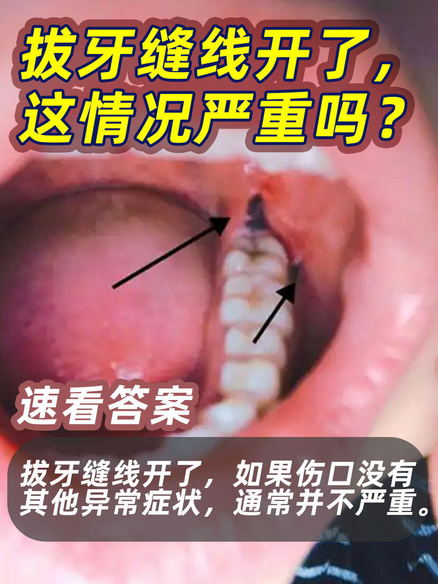 拔牙缝线开了，这情况严重吗？速看答案