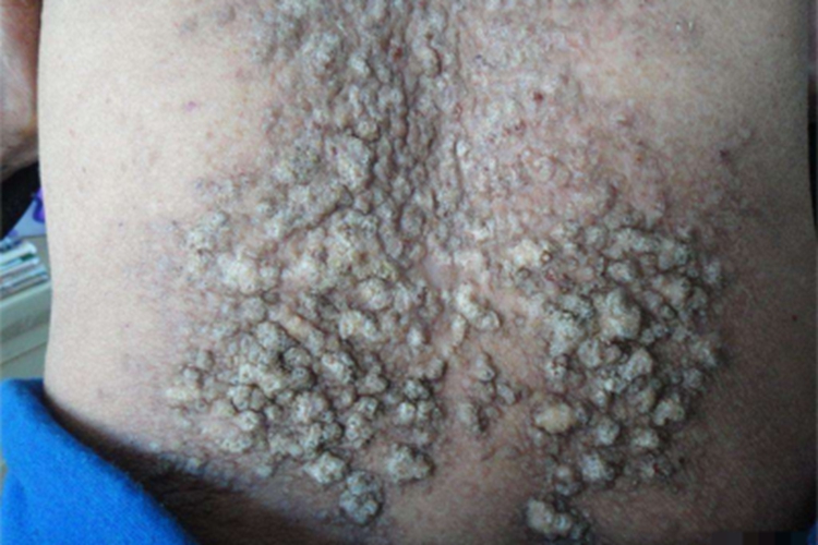 皮肤淀粉样变大疙瘩图