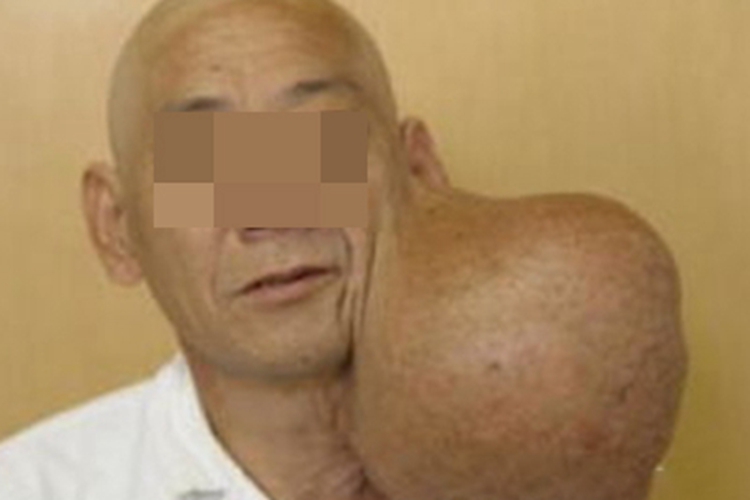 腮腺混合瘤耳周瘤图