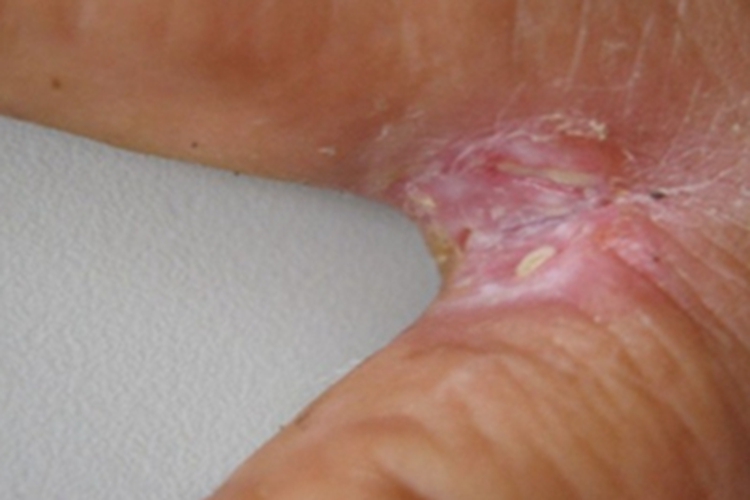 浸渍糜烂型手癣手指缝化脓糜烂图
