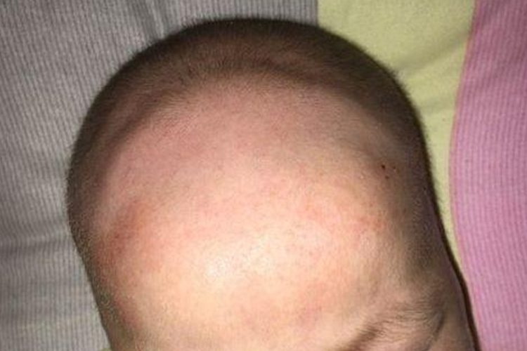 婴儿杂合型软骨发育不良图 婴儿杂合型软骨发育不良图