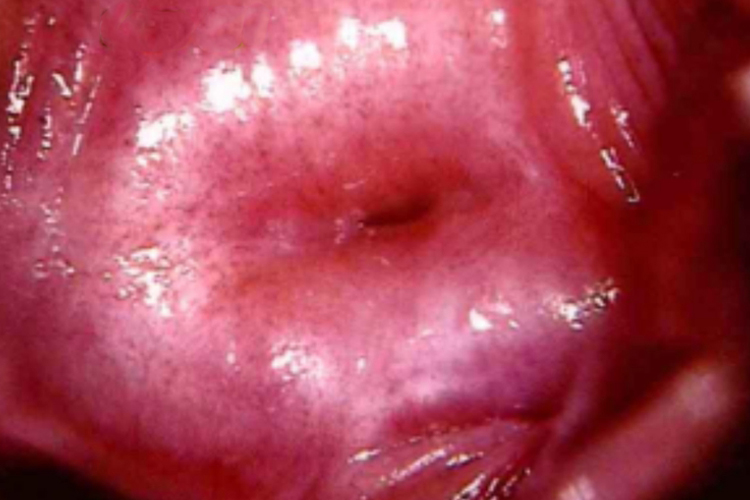 宫颈衰老图 宫颈衰老图