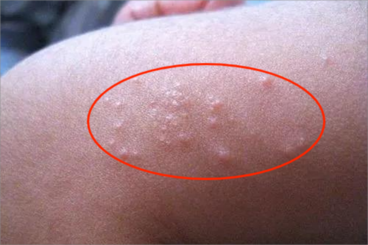 光泽苔藓小红疙瘩图