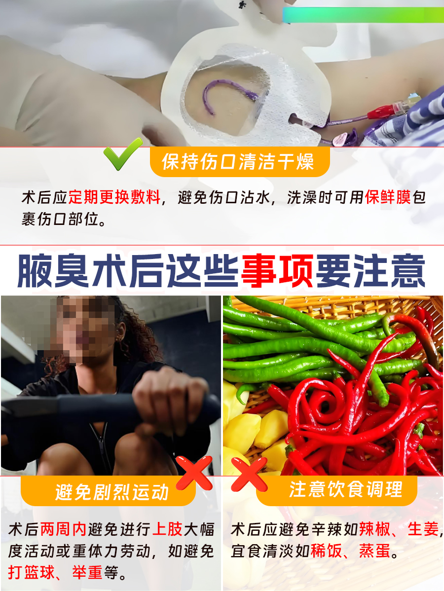 腋臭不再来,优选手术大盘点