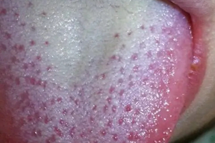 普通型猩红热舌头症状图