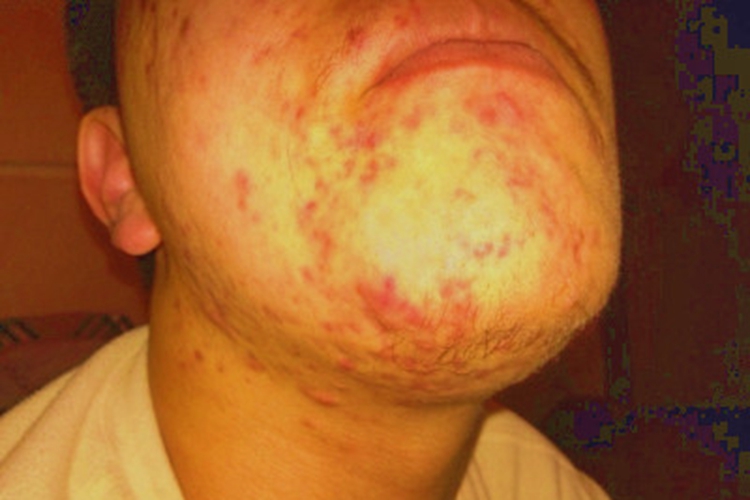 结节病下巴症状图