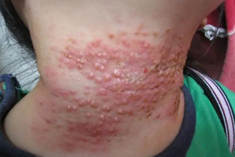 间擦疹前颈疙瘩糜烂图