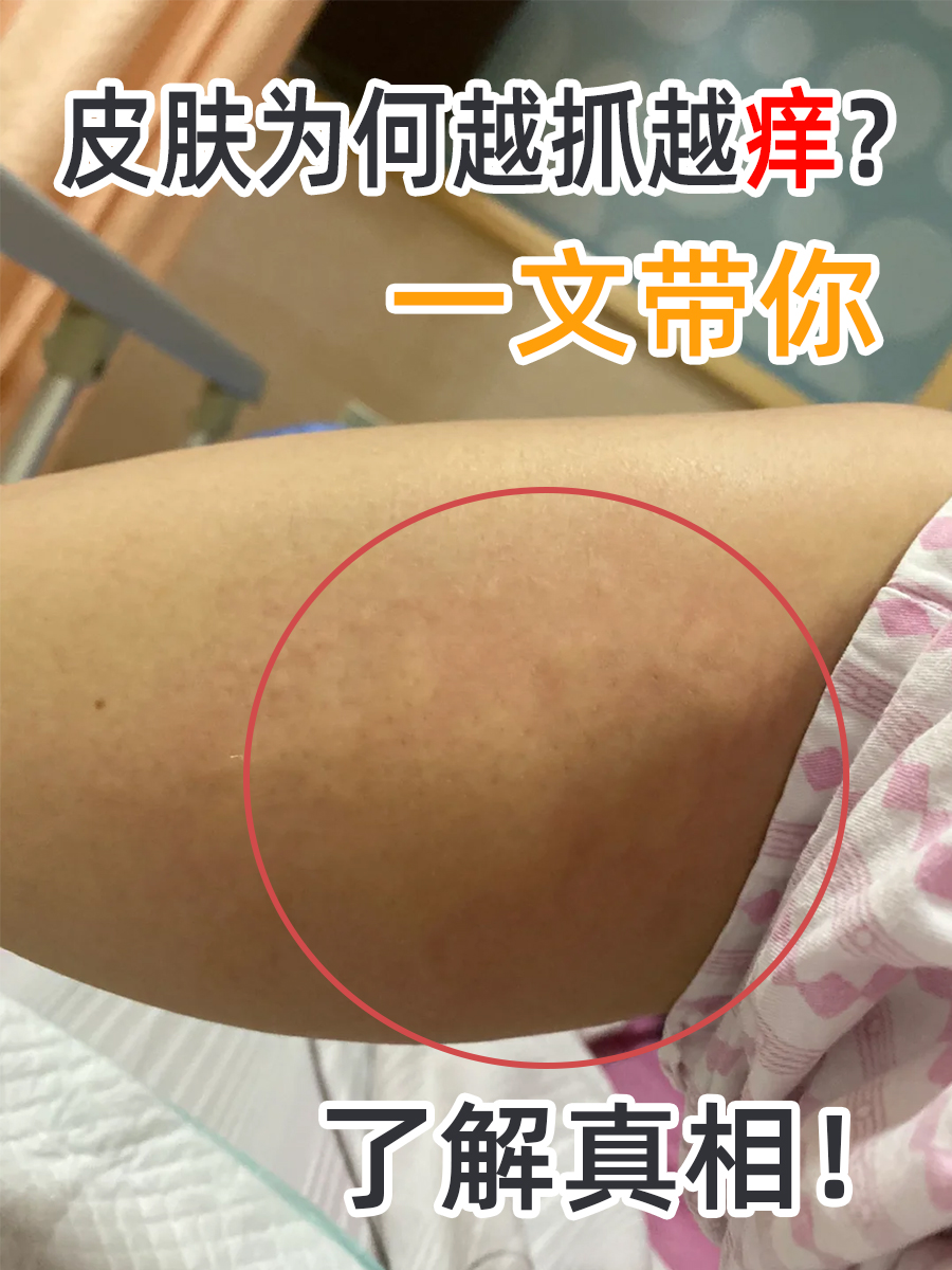 皮肤为何越抓越痒?一文带你了解真相!