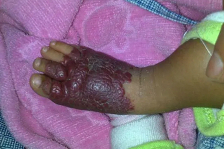 蔓状血管瘤脚背症状图 蔓状血管瘤脚背症状图