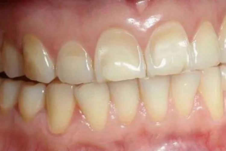 酸蚀症牙齿缺损有凹陷图