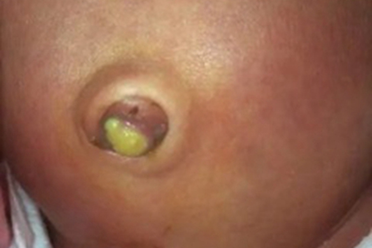脐窝湿疹肚脐内流黄脓图