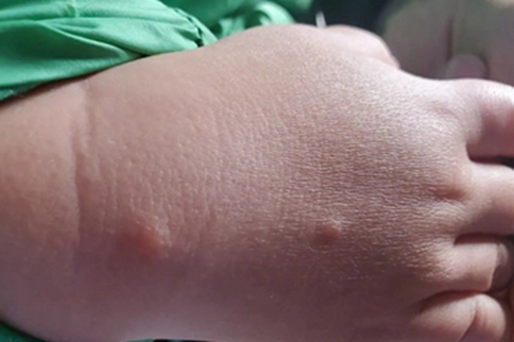 蚊虫叮咬手背长丘疹图