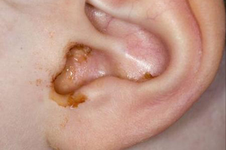 急性化脓性中耳炎图 急性化脓性中耳炎图