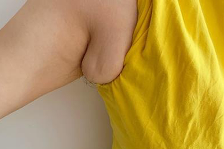 男性腋下副乳图 男性腋下副乳图