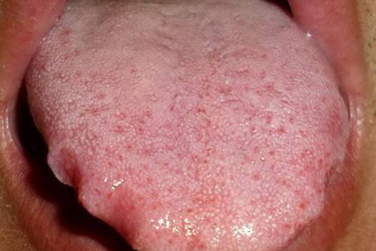 脾胃虚寒慢性胃炎舌苔图 脾胃虚寒慢性胃炎舌苔图