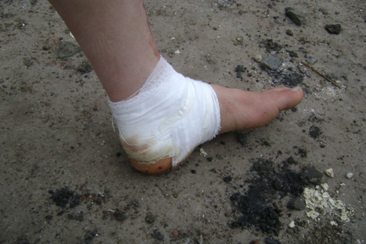 脚跟受伤“8”字形包扎法图