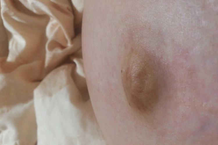 怀孕肚脐眼凸出图