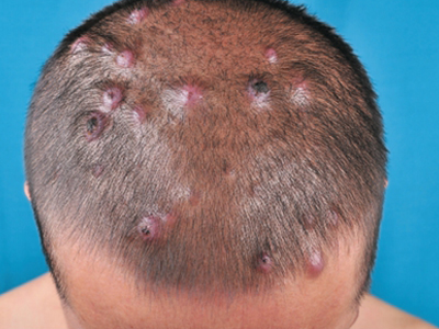毛鞘棘皮瘤头皮上长很多带黑痂的疙瘩图.jpg