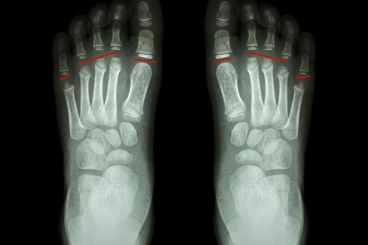 儿童足部骨骺线未闭合图
