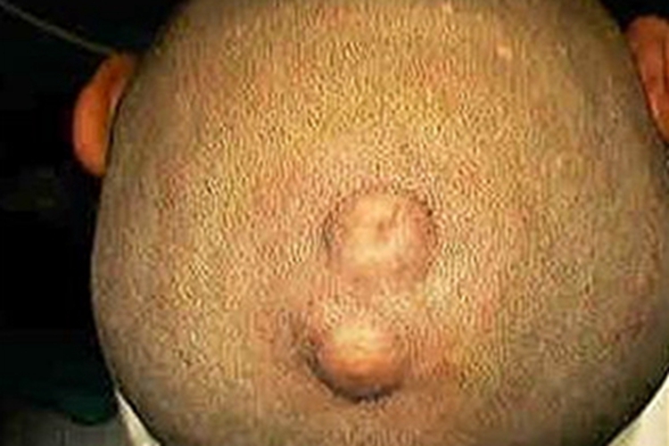 多形性脂肪瘤头部鼓包图