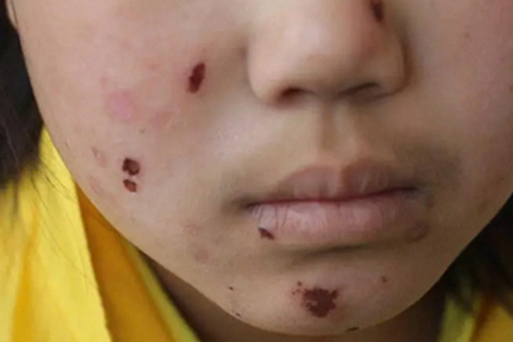 人工皮炎面部血痂图