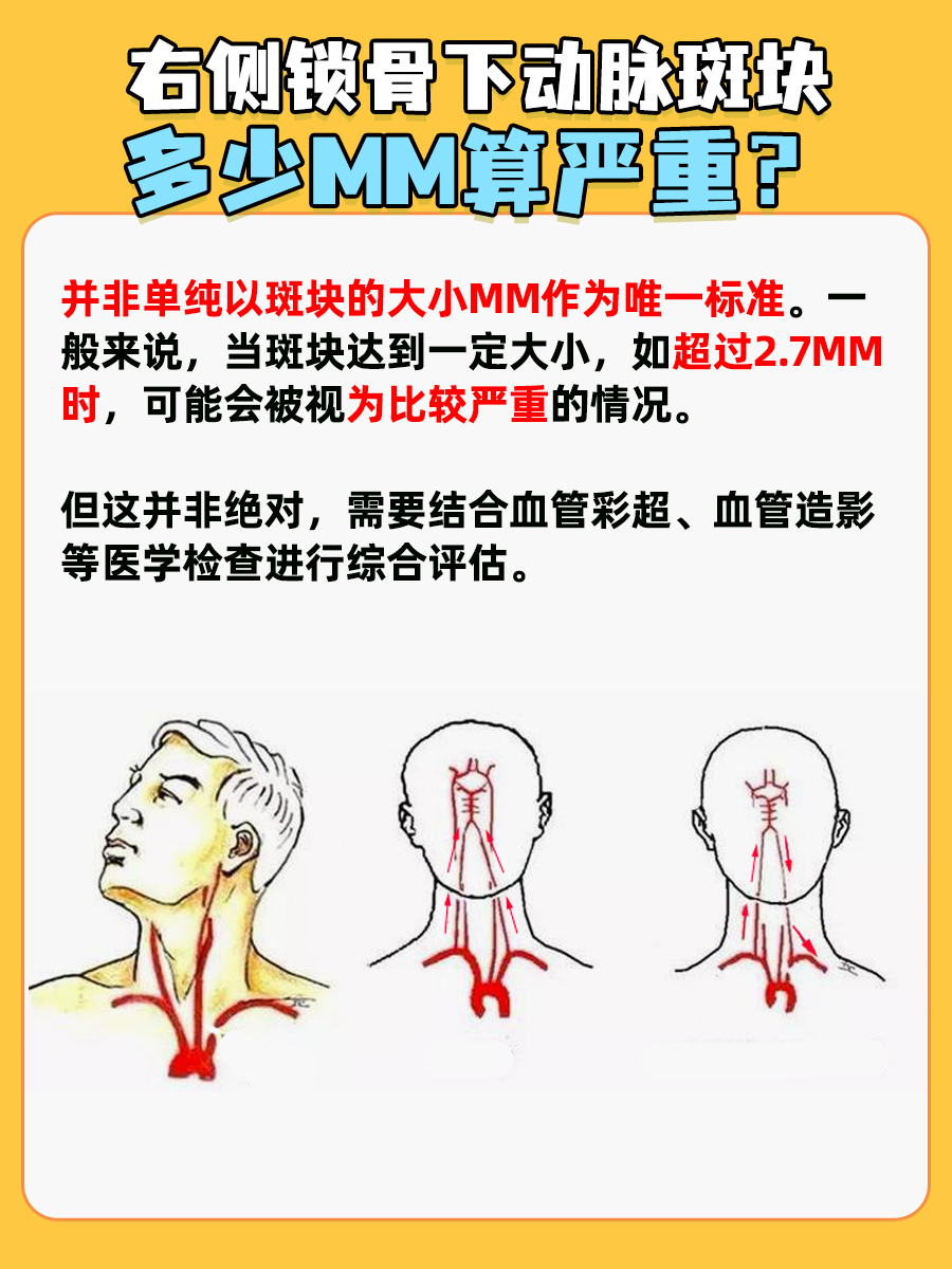 带你了解，右侧锁骨下动脉斑块多少mm算严重