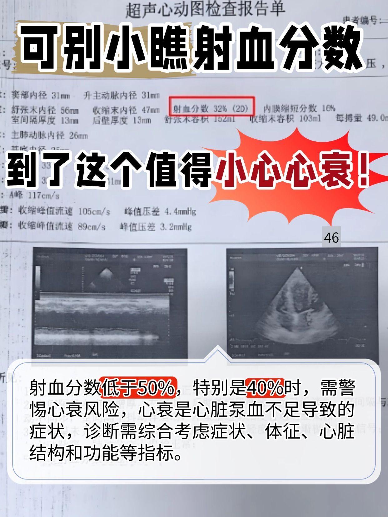 可别小瞧射血分数，到了这个值得小心心衰！