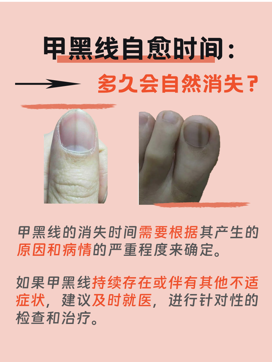 甲黑线自愈时间：多久会自然消失？