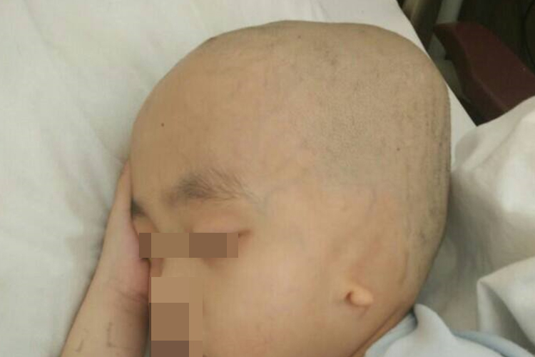 4个月婴儿脑积水枕骨突出图 4个月婴儿脑积水枕骨突出图