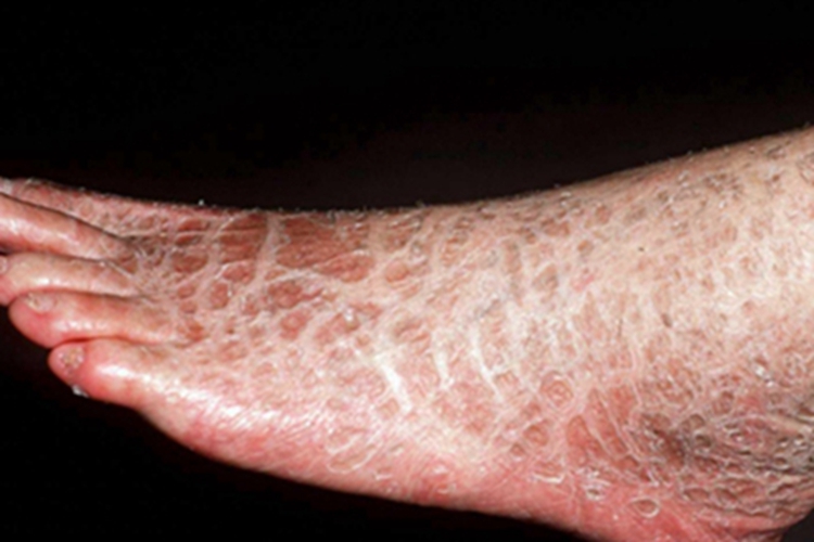 鱼鳞病脚背症状图