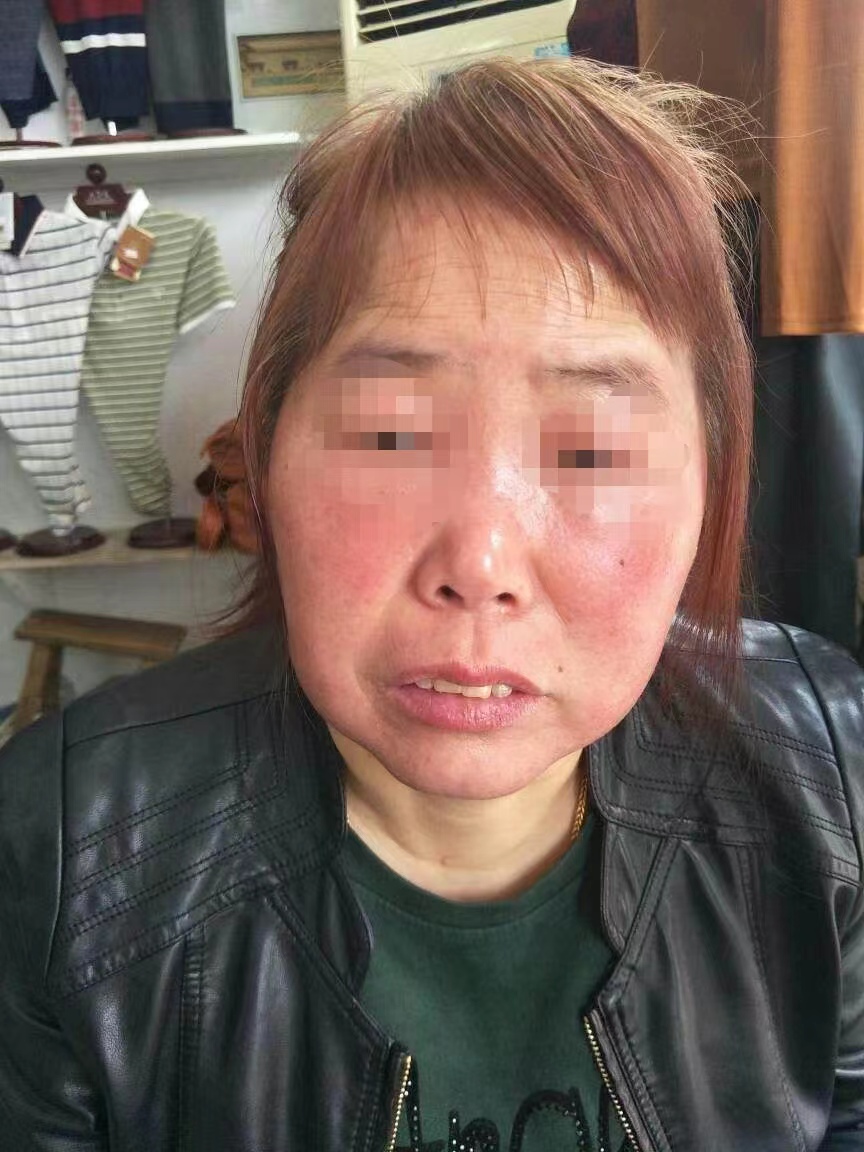 肾病脸部浮肿图片