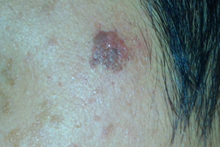 浅表扩散性黑素瘤症状图