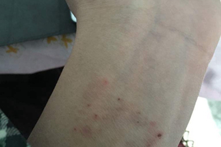 镍皮炎左手腕有红疙瘩图