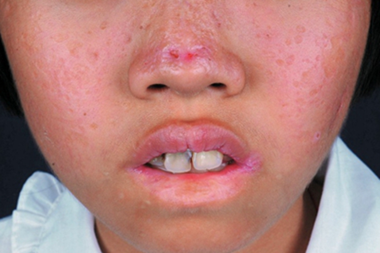 痘疮样水疱病面部瘢痕图