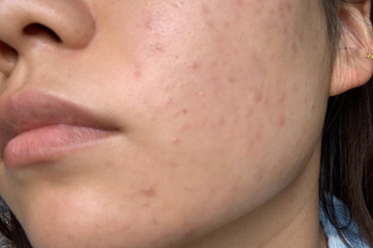 痤疮脸上有小疙瘩图